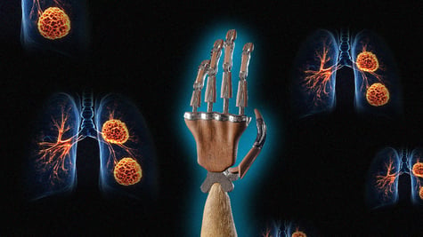 lung cancer AI