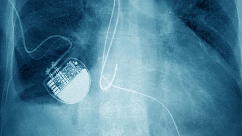 Heart pacemaker