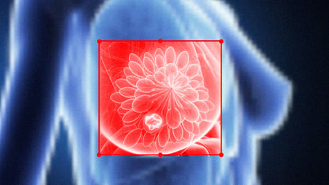 breast cancer and ai