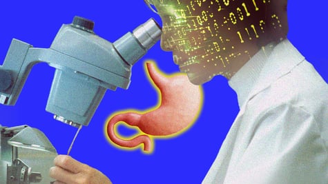 AI tool for stomach cancer