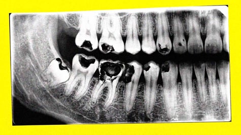 A close-up of a dental x-ray.