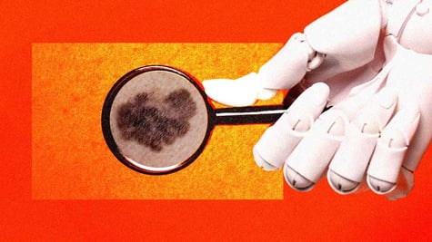 skin cancer detection