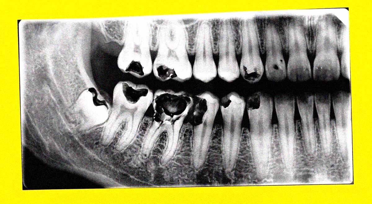 A close-up of a dental x-ray.