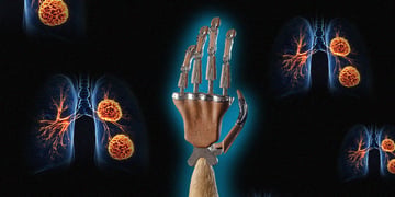 lung cancer AI