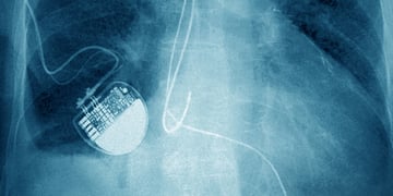 Heart pacemaker