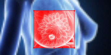 breast cancer and ai