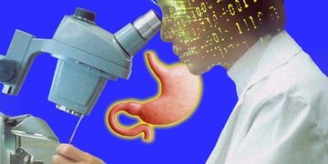 AI tool for stomach cancer