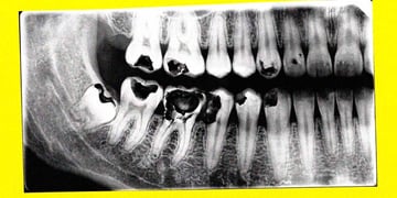 A close-up of a dental x-ray.
