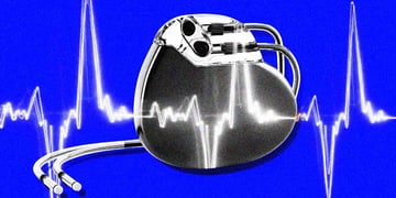 A pacemaker, an EKG tracing of a heart rate