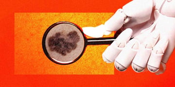skin cancer detection